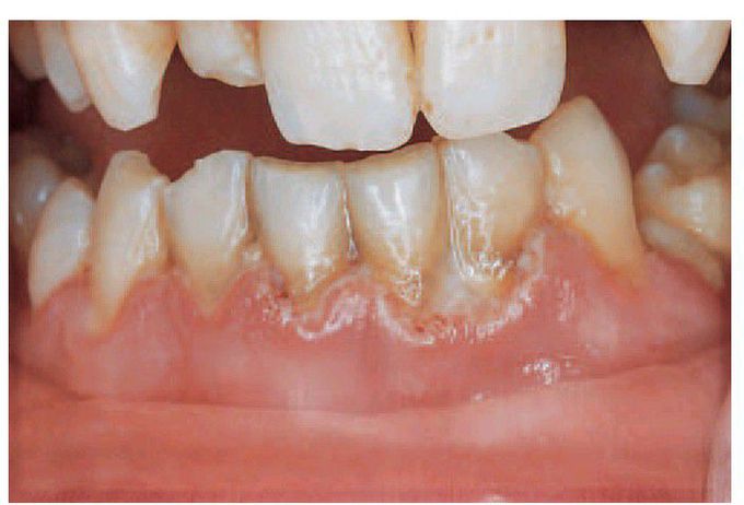 Acute necrotising ulcerative gingivitis