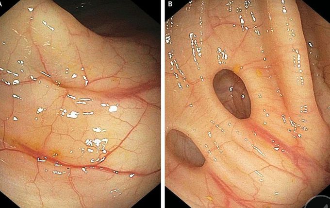 Diverticulitis