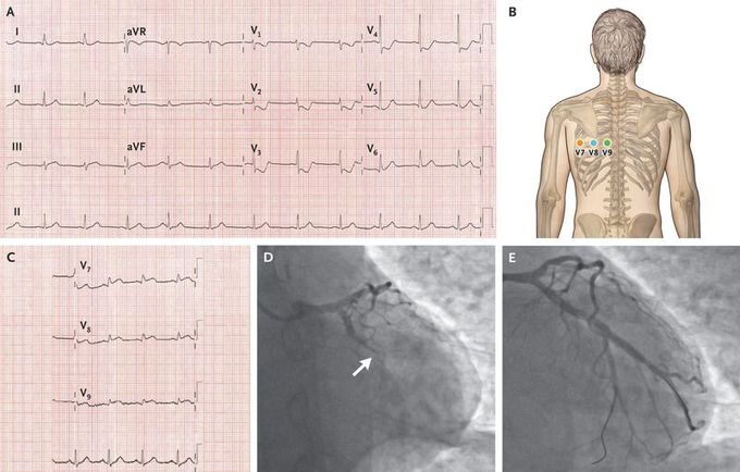 Posterior-Wall Myocardial Infarction