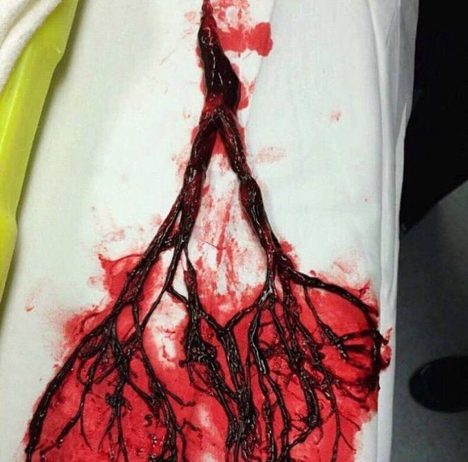 Un coágulo de sangrado pulmonar masivo.