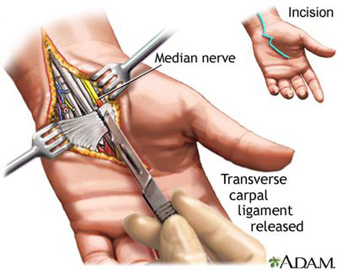 Risk Factors of Carpal Tunnel Syndrome