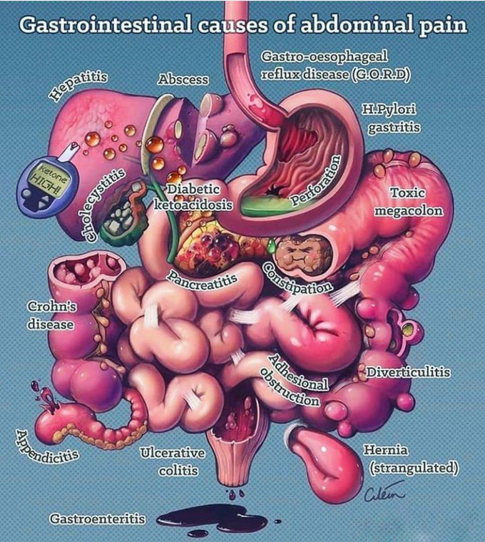 Gastrointestinal causes of abdominal pain