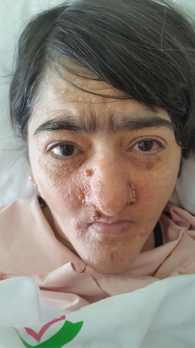 tuberussclrosis
