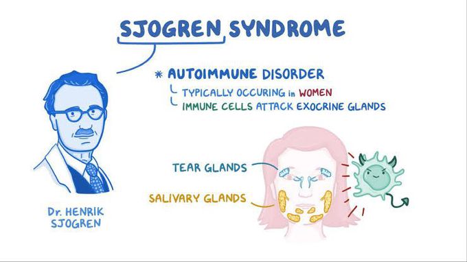 Sjogren syndrome - MEDizzy