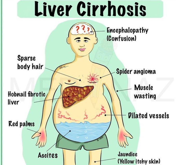 Liver cirrhosis - MEDizzy