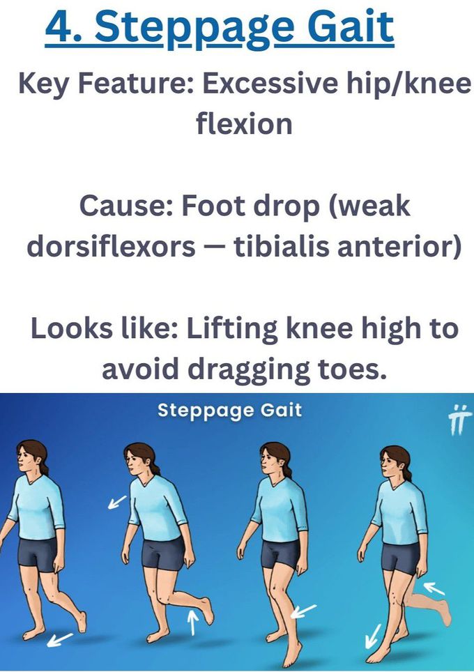 Steppage Gait
