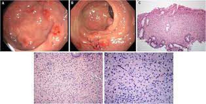 Symptoms of malakoplakia