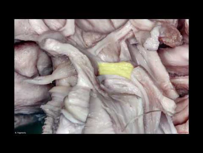 Internal Structures and Safe Entry Zones of the Brainstem