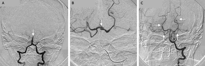 Selective Intraarterial Thrombolysis for Cardioembolic Stroke