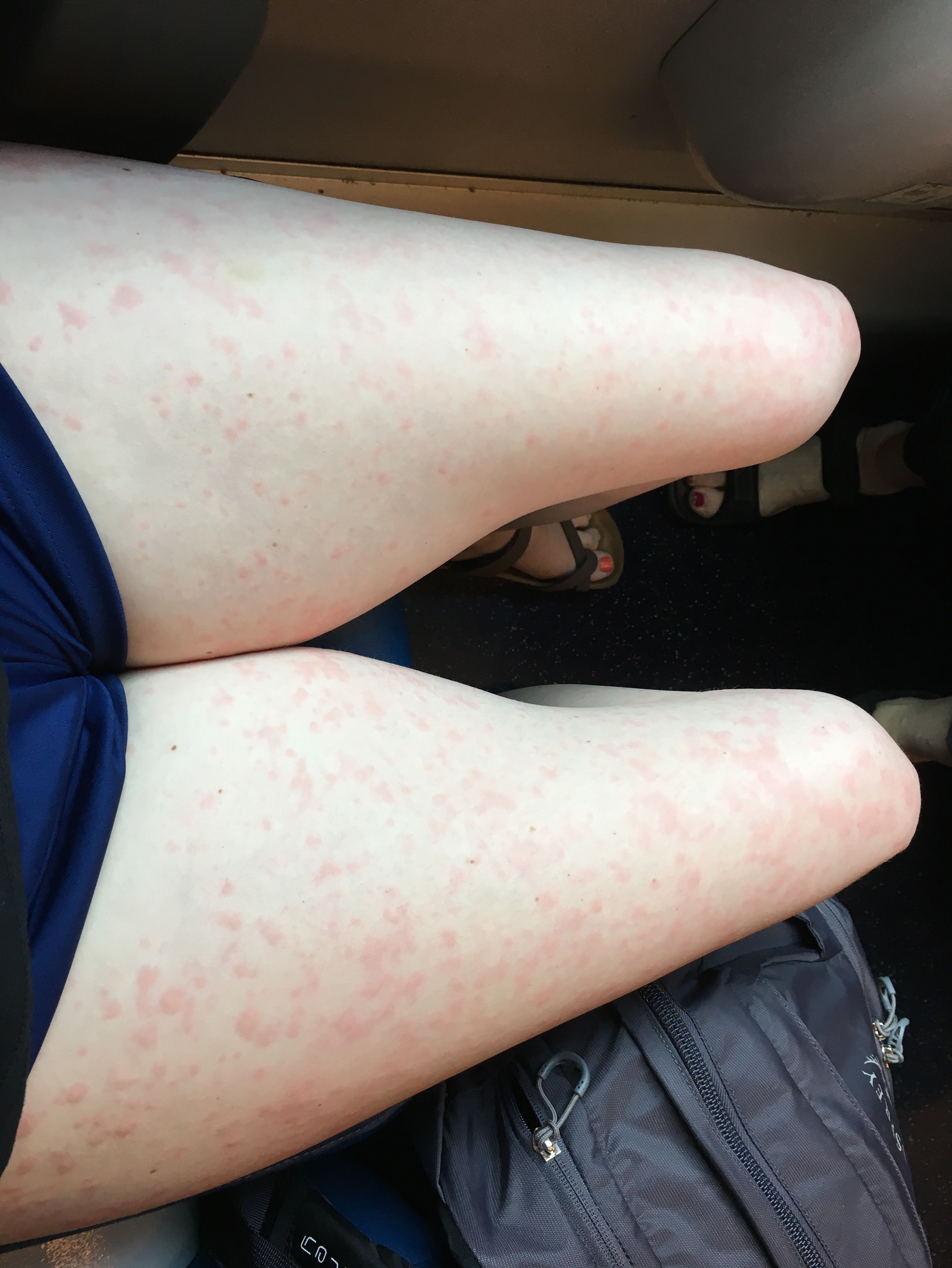 Can Mono Cause Hives
