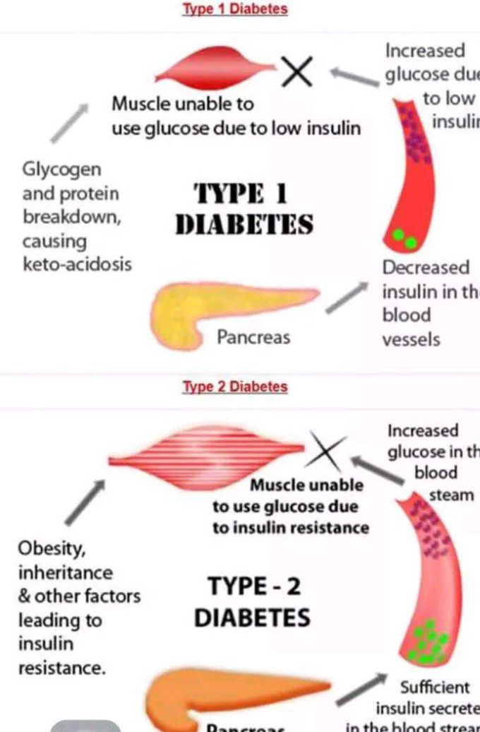 Types of diabetes