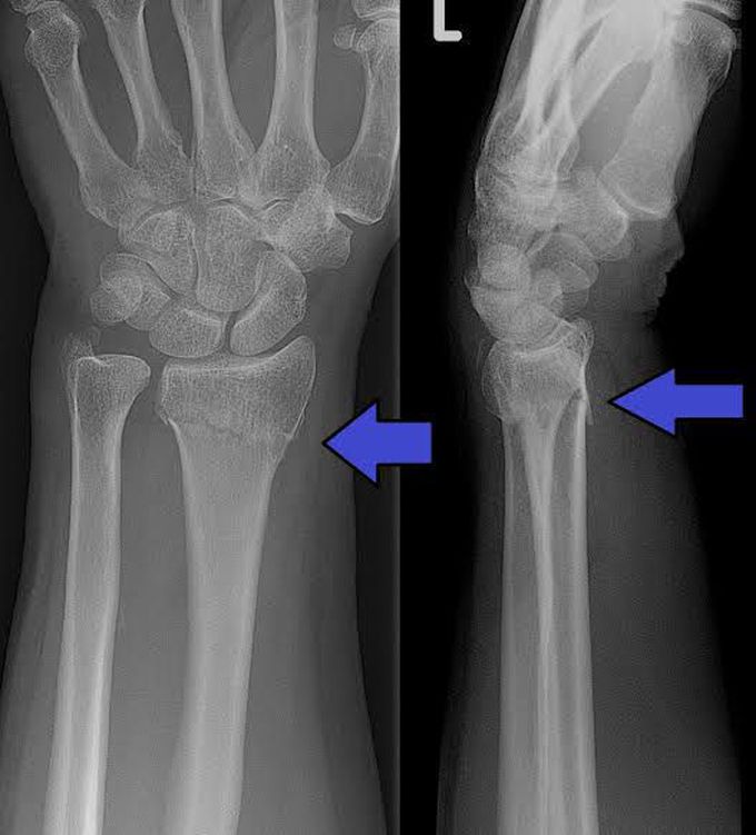 Colles fracture
