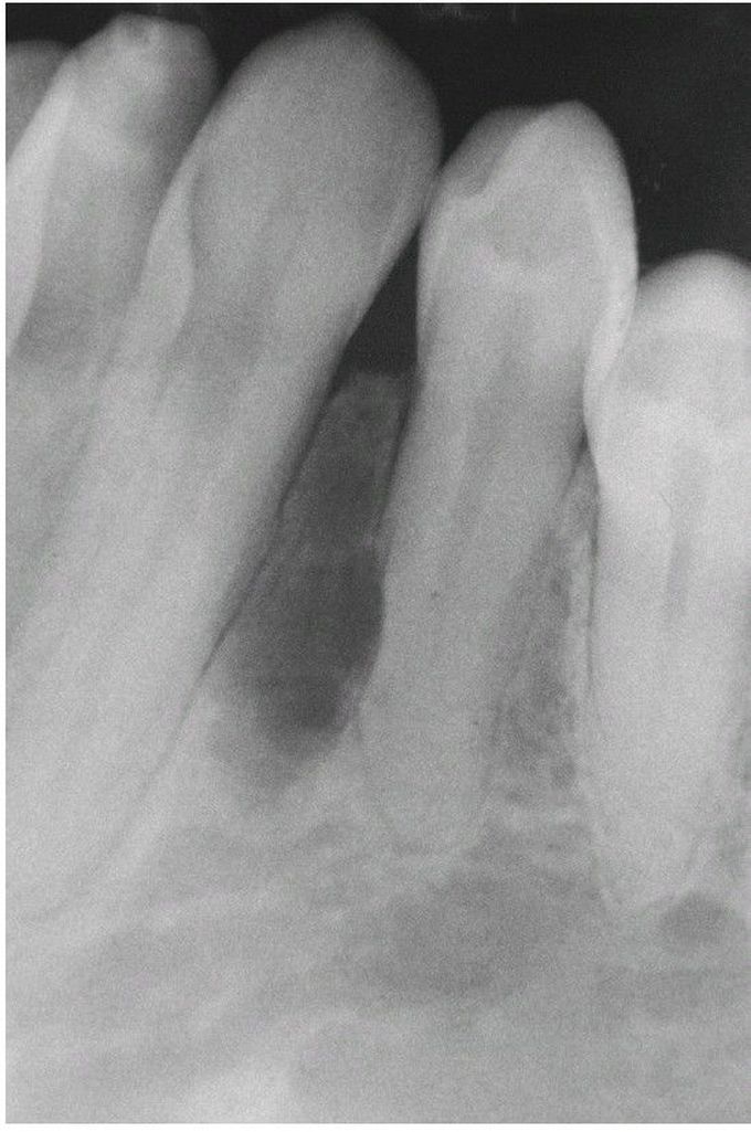 Ameloblastoma Radiograph