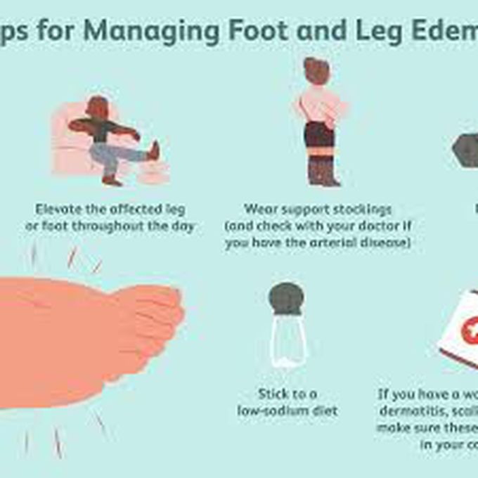 Treatment of edema