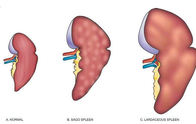 Amyloidosis in liver