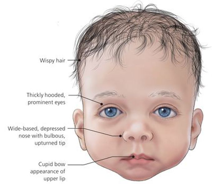 Noonan Syndrome