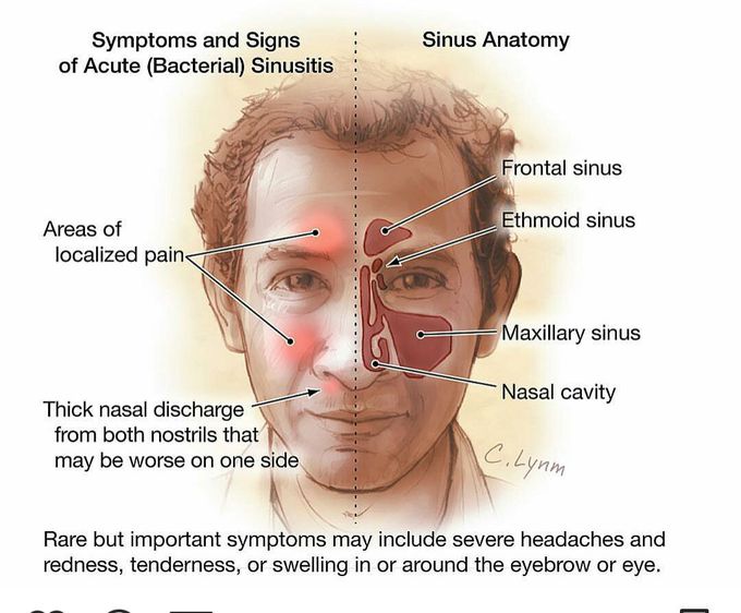 Sinusitis