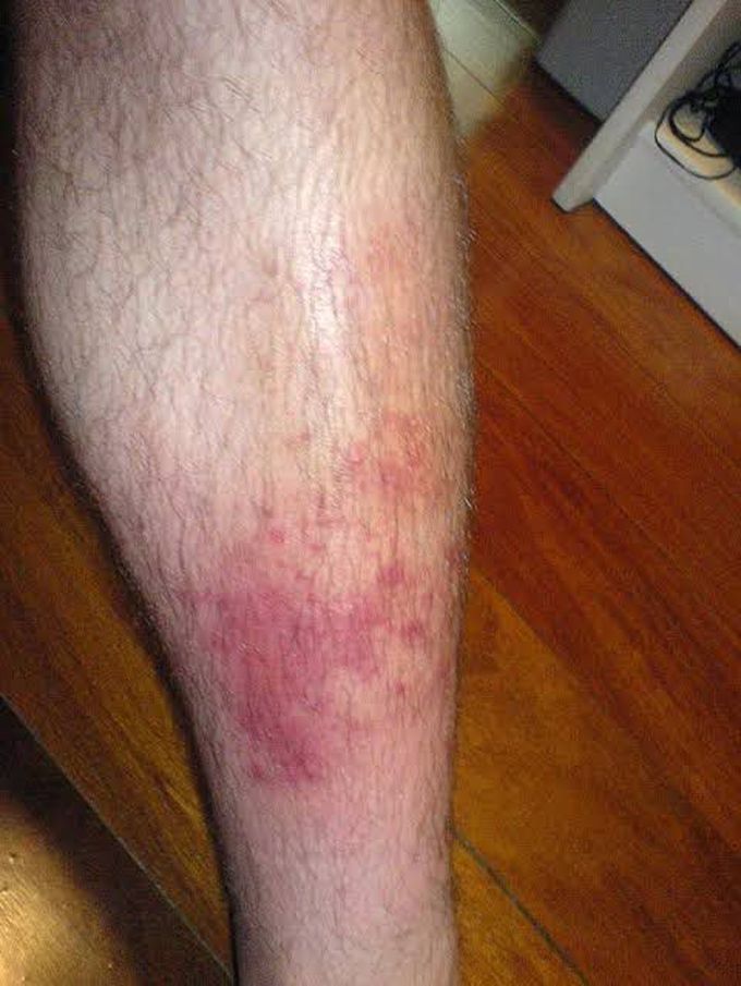 Cellulitis and its symptoms