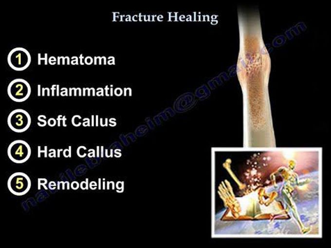 Fracture Healing