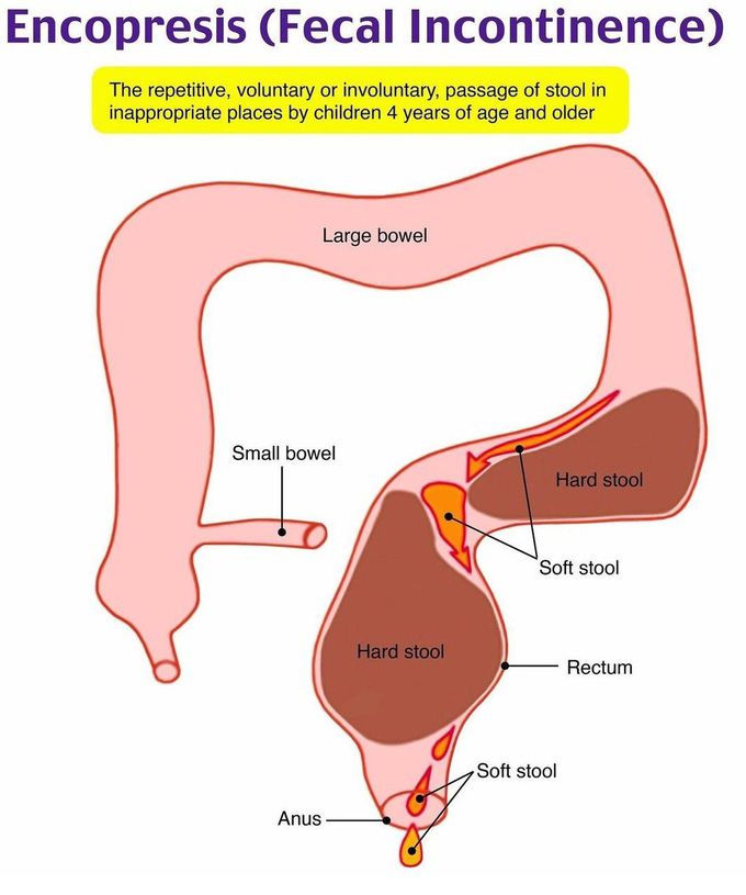 Encopresis