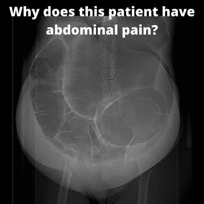 Abdominal Pain