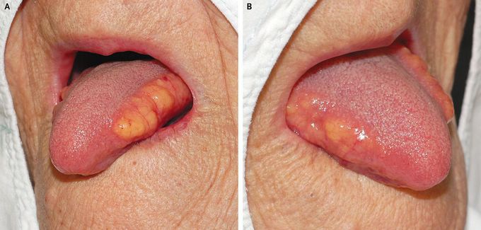 Symmetric Lipomatosis of the Tongue