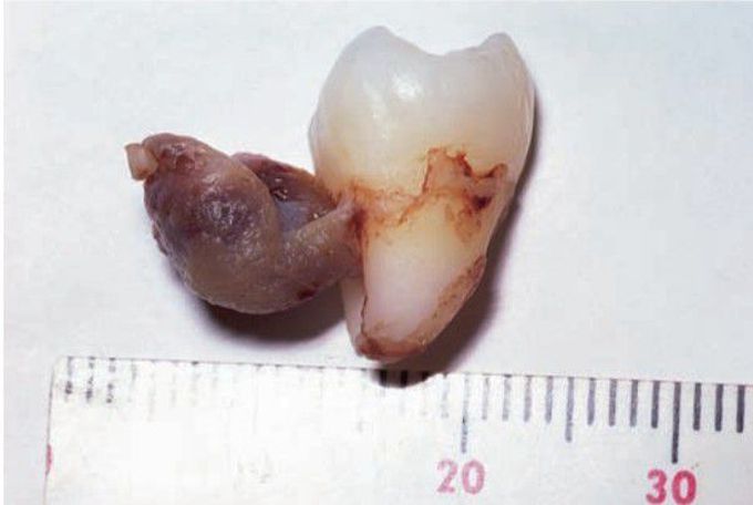 Paradental cyst (variant of dentigerous cyst)
