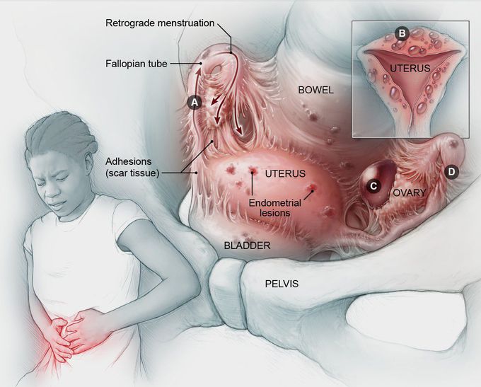 ENDOMETRIOSIS