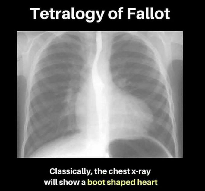 Tetralogy of  fallot