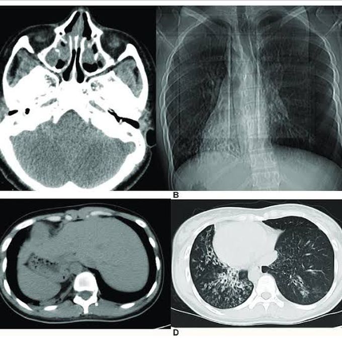 Kartagener syndrome treatment