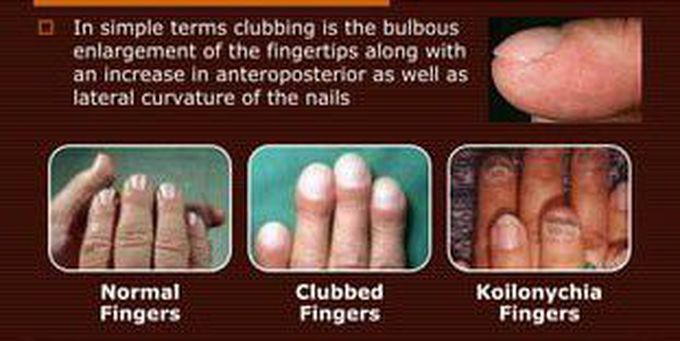 Symptoms of Clubbing
