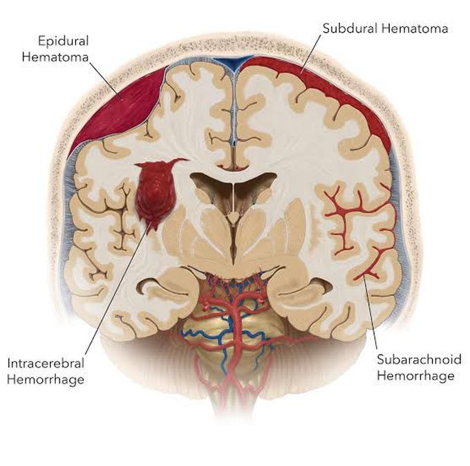 Subarachnoid Hemorrhage Medizzy