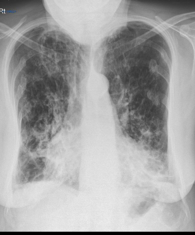 Radiological Findings in Bronchiectasis