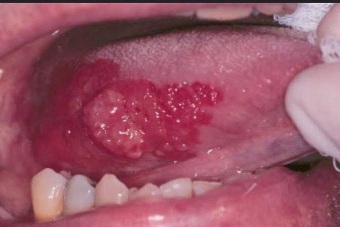 Erythroplakia