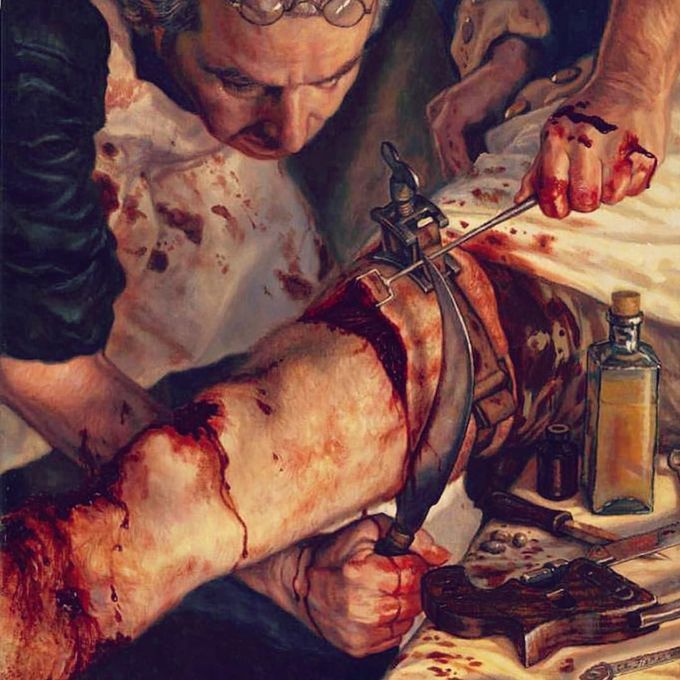 Without anesthesia amputation