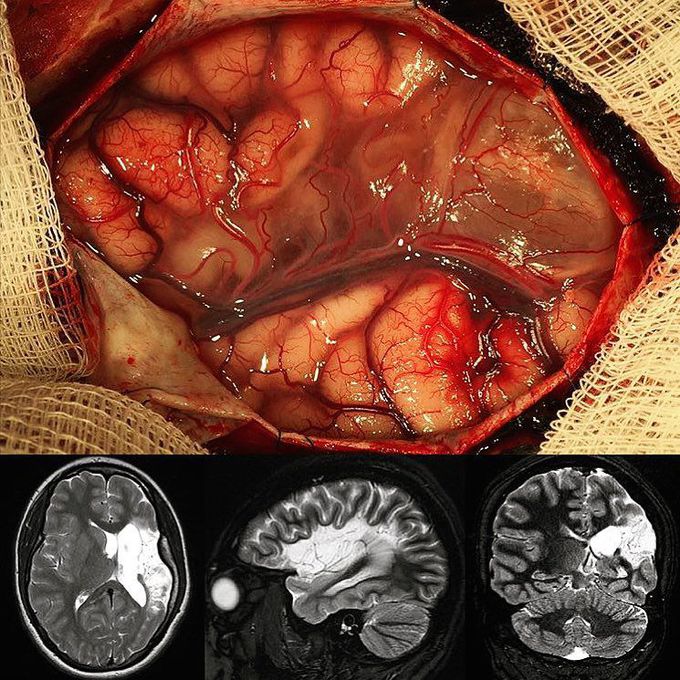 Perinatal intracerebral hemorrhage