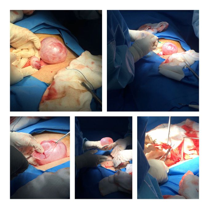 Corpus luteum cyst