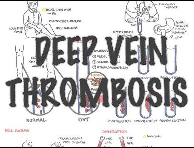 Deep Vein Thrombosis - Overview (pathophysiology, treatment, complications)