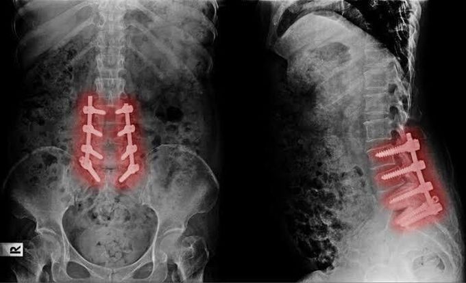 Failed back surgery syndrome