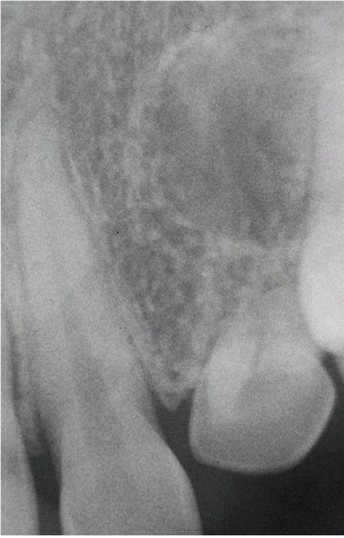 Tuberous Sclerosis radiograph
