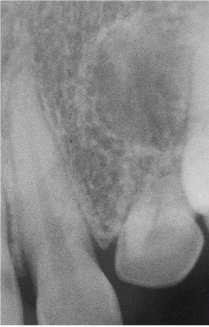 Tuberous Sclerosis radiograph