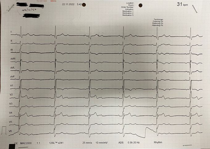 AV Block Type 2 Mobitz 2