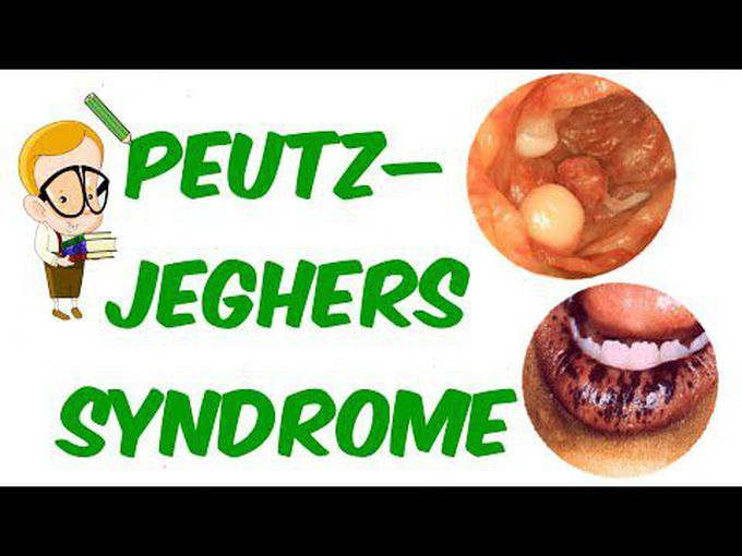 Peutz-Jeghers Syndrome: Introduction