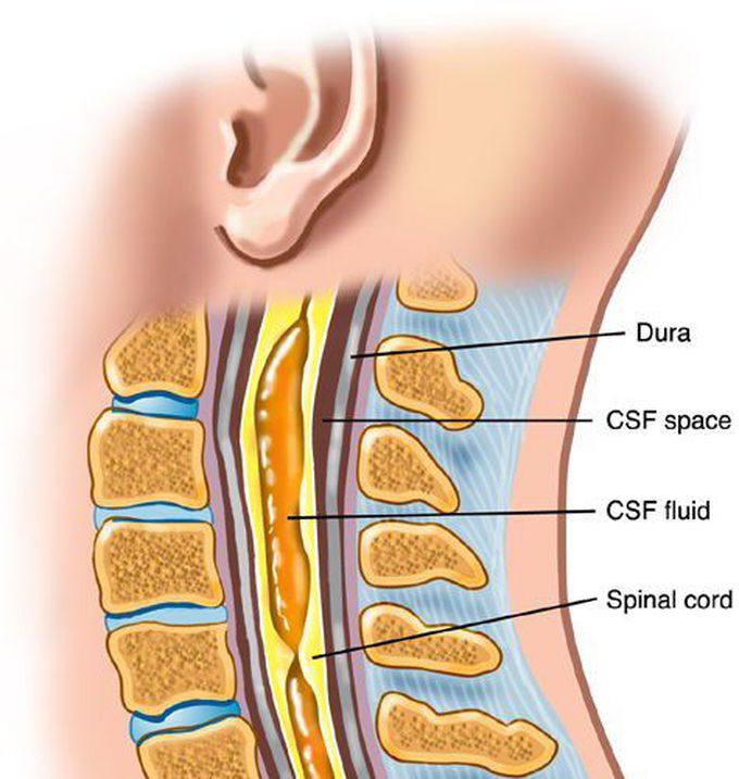 syringomyelia spinal cord