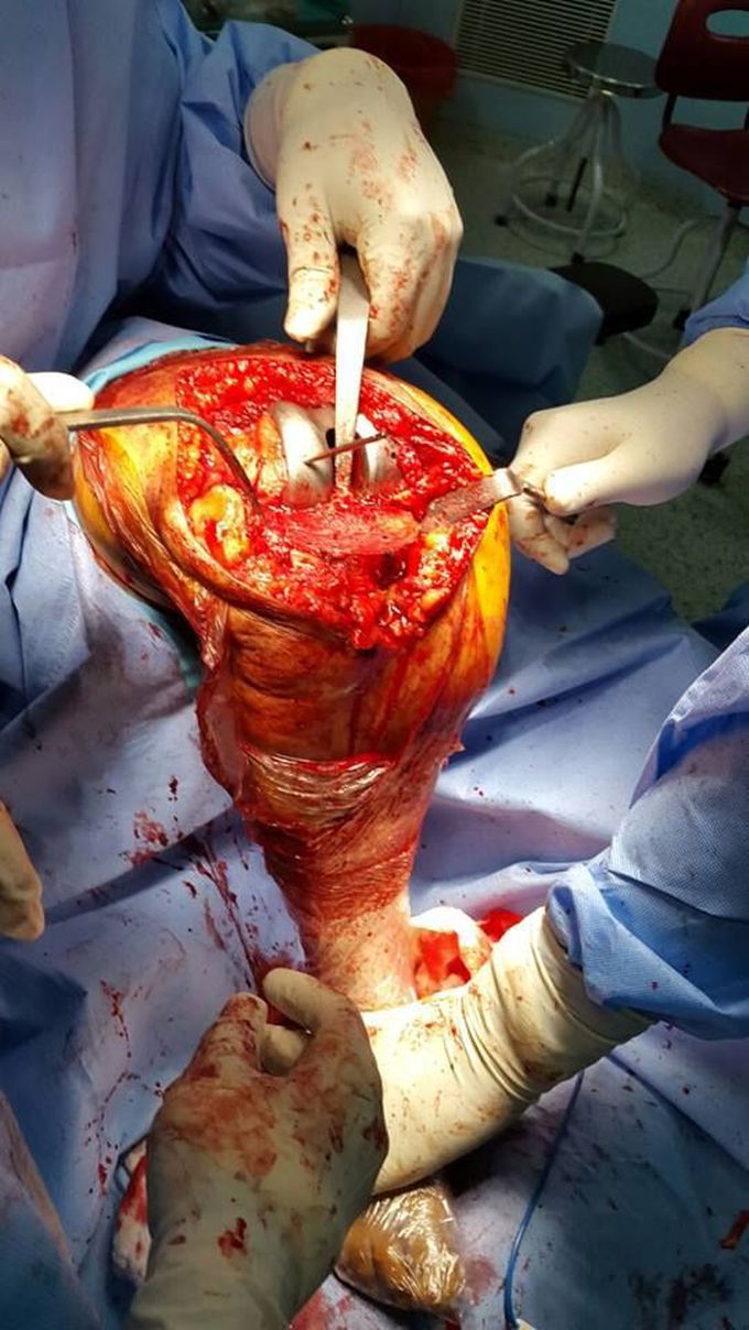 Total Knee Replacement