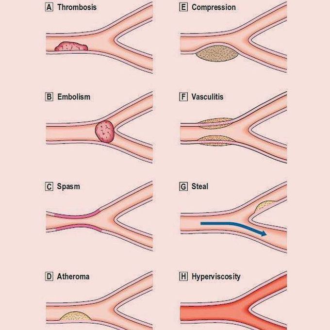 Ischemia Causes