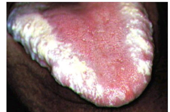 Hairy leukoplakia
