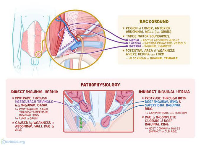 Hesselbach triangle hernia