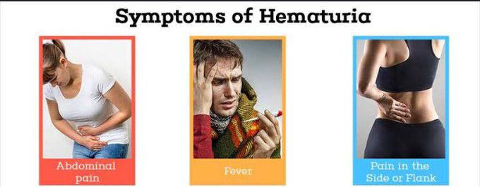 Symptoms of Hematuria