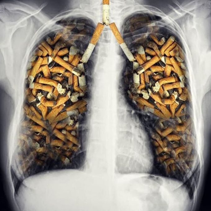 Smoking and lung cancer